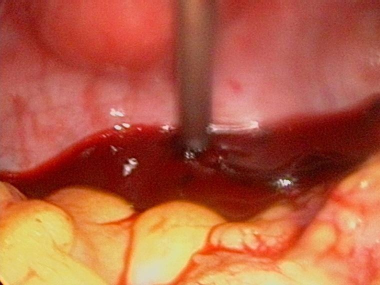 pouch of douglas blood clots corpus luteum